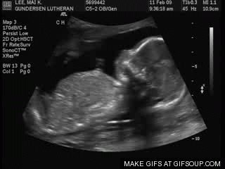 Archivo:Ultrasonido a bebe.gif